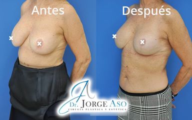 Reducción de senos - Dr. Jorge Aso