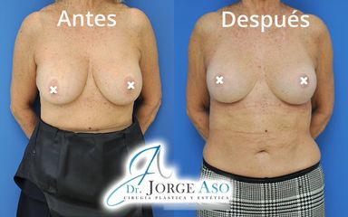 Reducción de senos - Dr. Jorge Aso