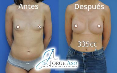 Aumento de pecho - Dr. Jorge Aso