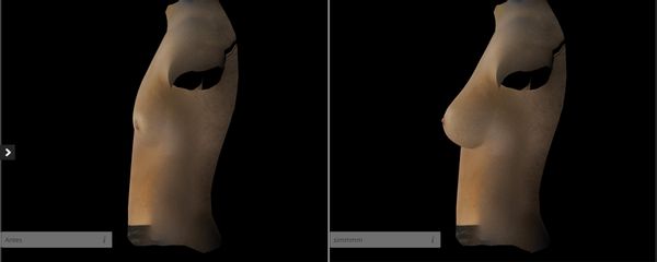 Simulación 3D Aumento de pecho - Dr. Jorge Aso