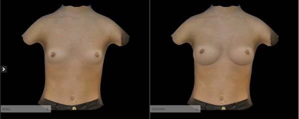Simulación 3D Aumento de pecho - Dr. Jorge Aso