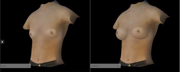 Simulación 3D Aumento de pecho - Dr. Jorge Aso