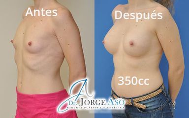 Aumento de pecho - Dr. Jorge Aso