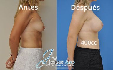 Aumento de pecho - Dr. Jorge Aso