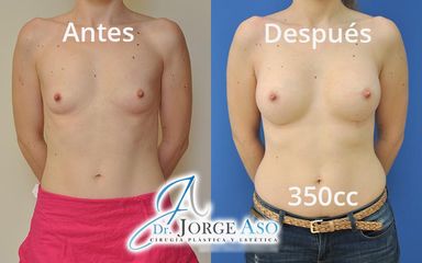 Aumento de pecho - Dr. Jorge Aso