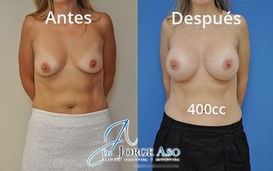 Aumento de pecho - Dr. Jorge Aso