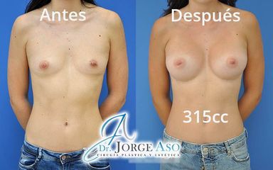 Aumento de pecho - Dr. Jorge Aso