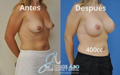 Aumento de pecho - Dr. Jorge Aso