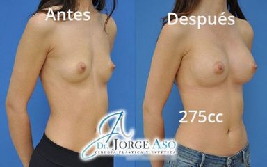 Aumento de pecho - Dr. Jorge Aso