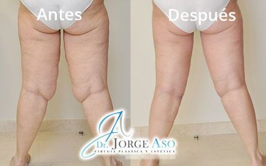Lifting muslos - Dr. Jorge Aso