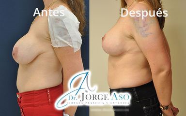 Mastopexia - Dr. Jorge Aso