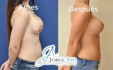 Mastopexia - Dr. Jorge Aso