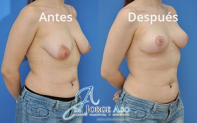 Mastopexia - Dr. Jorge Aso