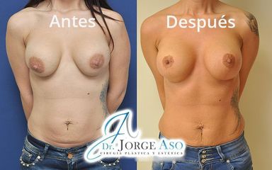 Mastopexia - Dr. Jorge Aso