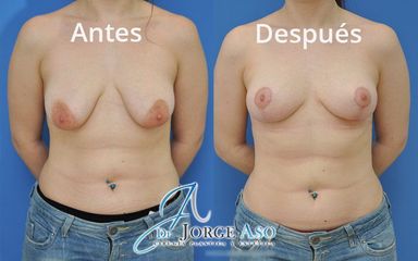 Mastopexia - Dr. Jorge Aso