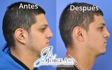 Rinoplastia - Dr. Jorge Aso