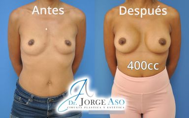 Aumento de pecho - Dr. Jorge Aso