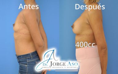 Aumento de pecho - Dr. Jorge Aso