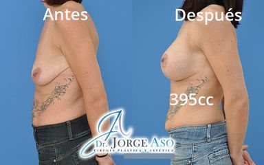 Mastopexia - Dr. Jorge Aso