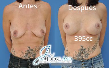 Mastopexia - Dr. Jorge Aso