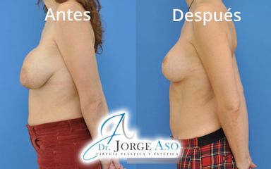 Mastopexia - Dr. Jorge Aso
