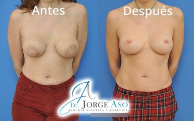 Mastopexia - Dr. Jorge Aso