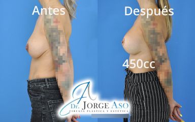 Mastopexia - Dr. Jorge Aso