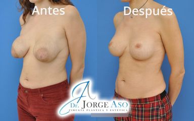 Mastopexia - Dr. Jorge Aso