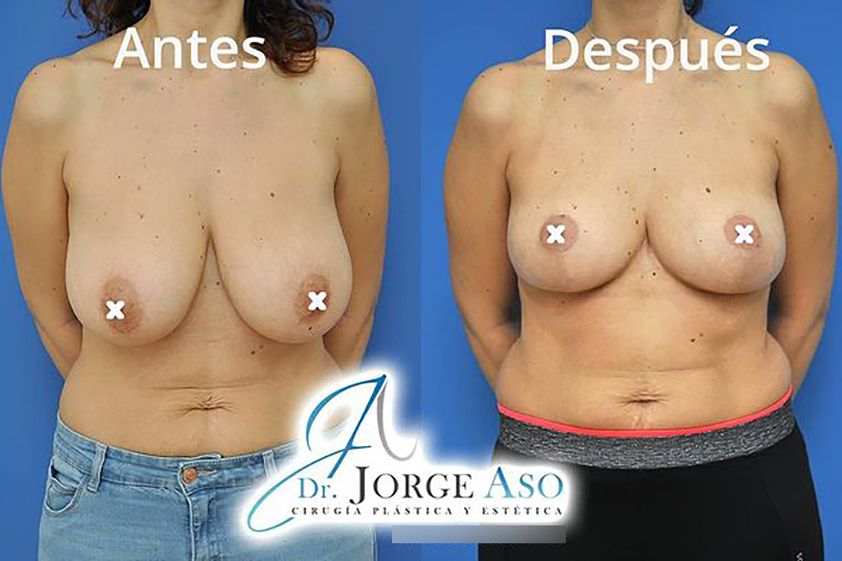 Reducción senos antes y después - 838945
