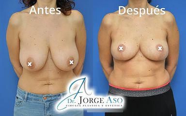 Reducción senos - Dr. Jorge Aso