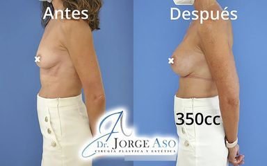 Aumento de pecho - Dr. Jorge Aso
