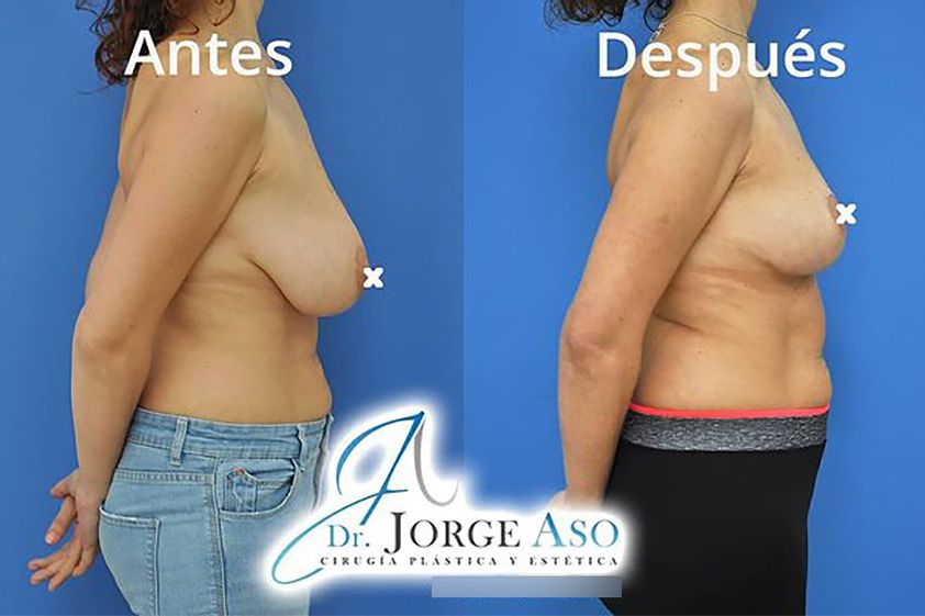 Reducción senos antes y después - 838948