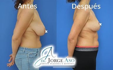Reducción senos - Dr. Jorge Aso