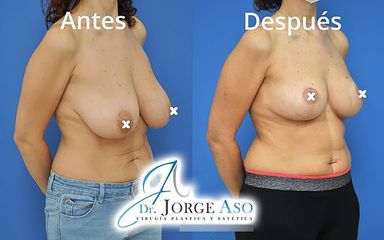 Reducción senos - Dr. Jorge Aso