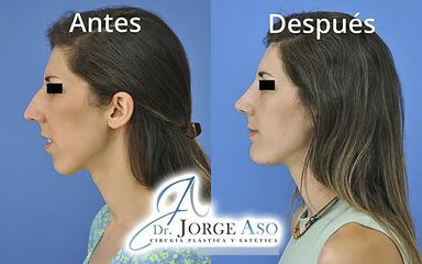 Rinoplastia + Mentoplastia - Dr. Jorge Aso