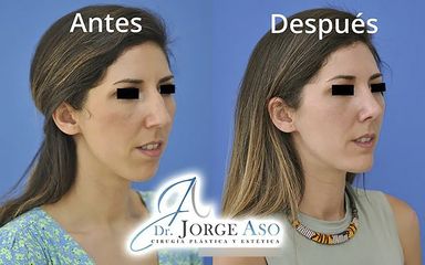 Rinoplastia + Mentoplastia - Dr. Jorge Aso