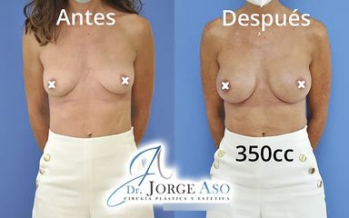 Aumento de pecho - Dr. Jorge Aso
