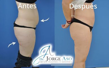 Liposucción - Dr. Jorge Aso
