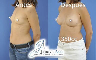 Aumento de pecho - Dr. Jorge Aso