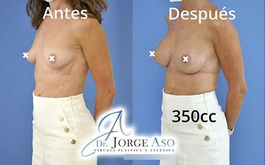 Aumento de pecho - Dr. Jorge Aso