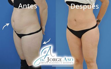Liposucción - Dr. Jorge Aso