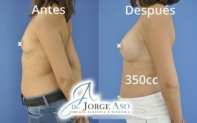 Aumento de pecho - Dr. Jorge Aso
