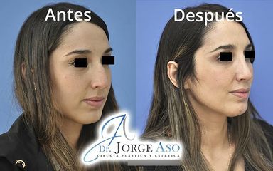 Rinoplastia - Dr. Jorge Aso