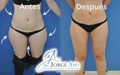 Liposucción - Dr. Jorge Aso