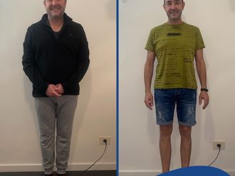 Tratamiento obesidad antes y después - 848793