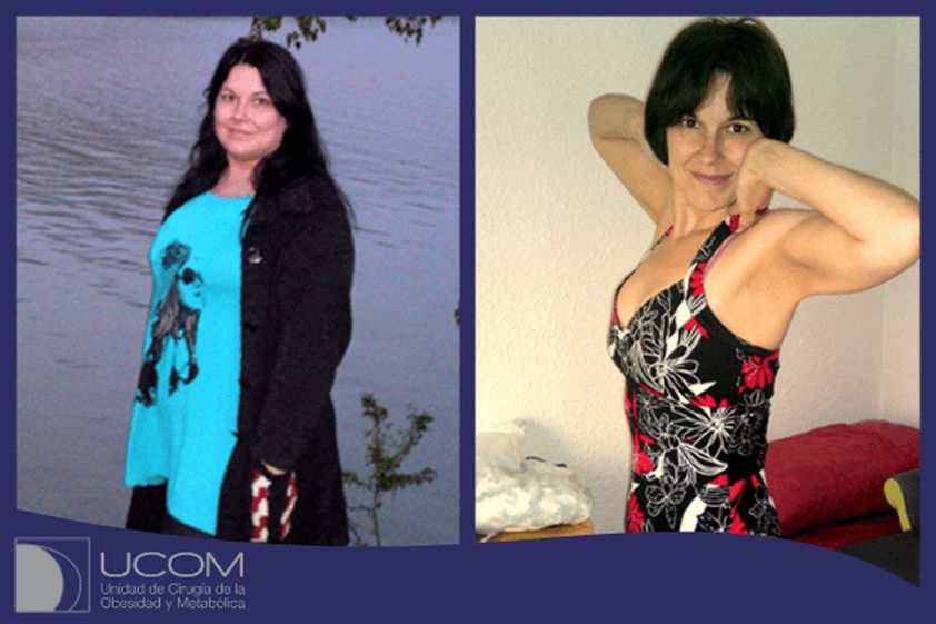 Tratamiento obesidad antes y después - 848795