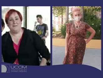 Tratamiento obesidad antes y después - 848797