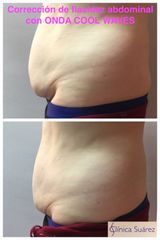 Antes y después Criolipolisis - Clínica Suárez