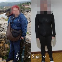 Balón gástrico - Clínica Suárez