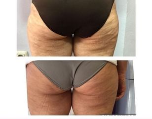 Antes y despues tratamiento combinado celulitis Clínica Suarez